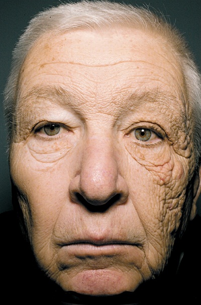 sun-damage-face-120604.jpg